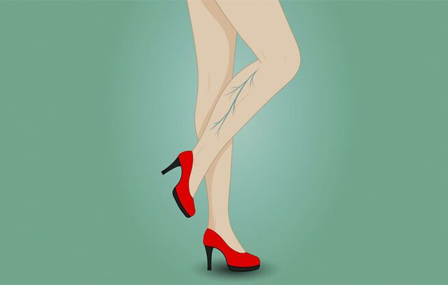 Vene varicose sulle gambe di una donna