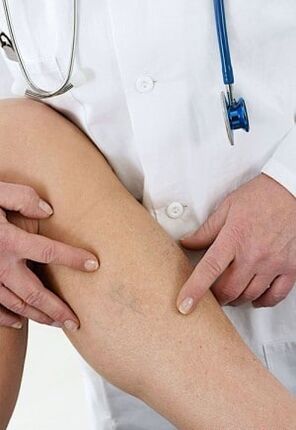 Vene varicose degli arti inferiori