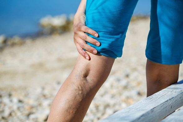 Dolore pungente alle gambe con vene varicose