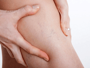 Dolore alle gambe con vene varicose