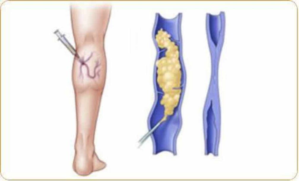 Un esempio di scleroterapia per le vene varicose e un risultato evidente